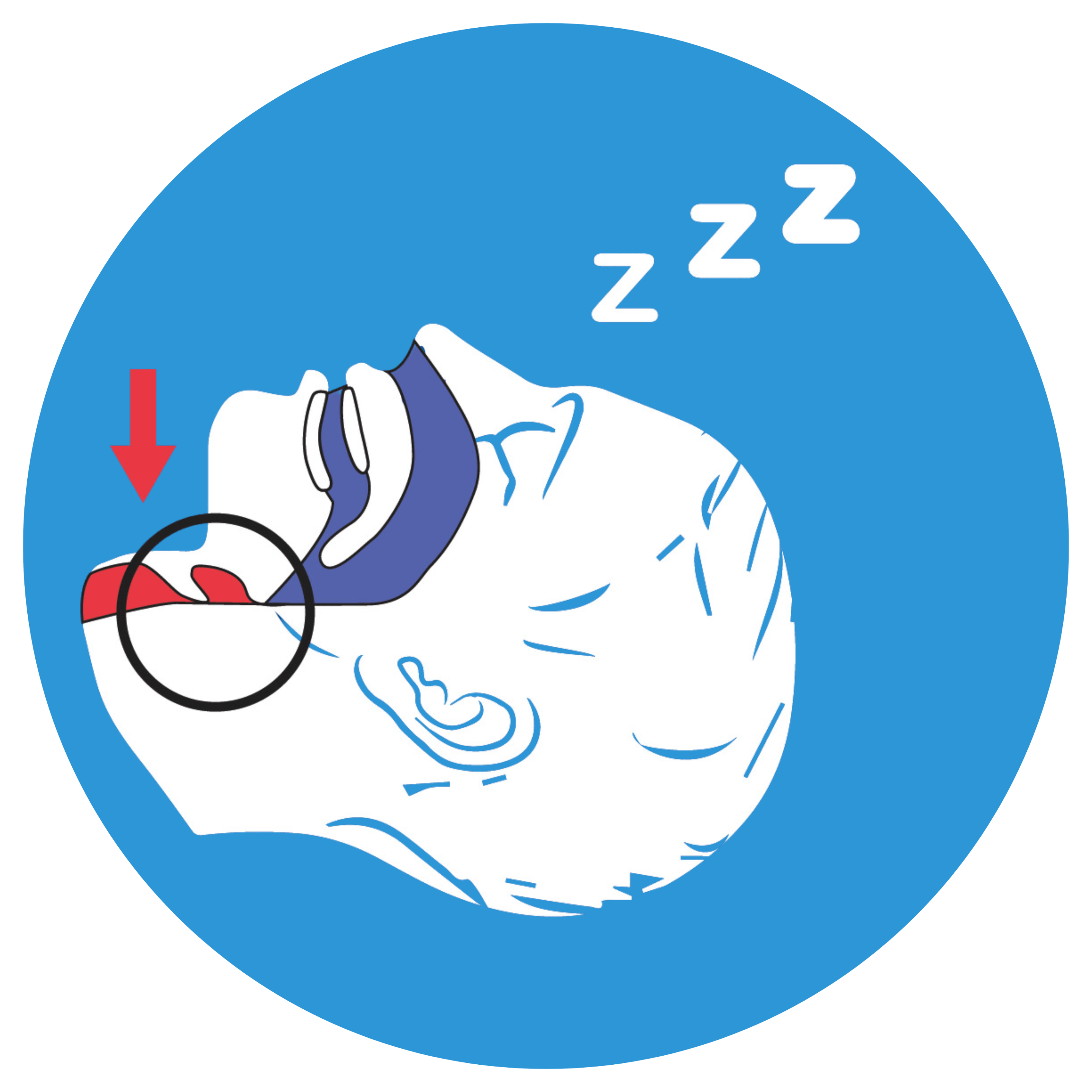 Démonstration de l'obstruction des voies respiratoires causé par l'arrière-langue pendant le sommeil, ce qui génère le ronflement et les apnées du sommeil.